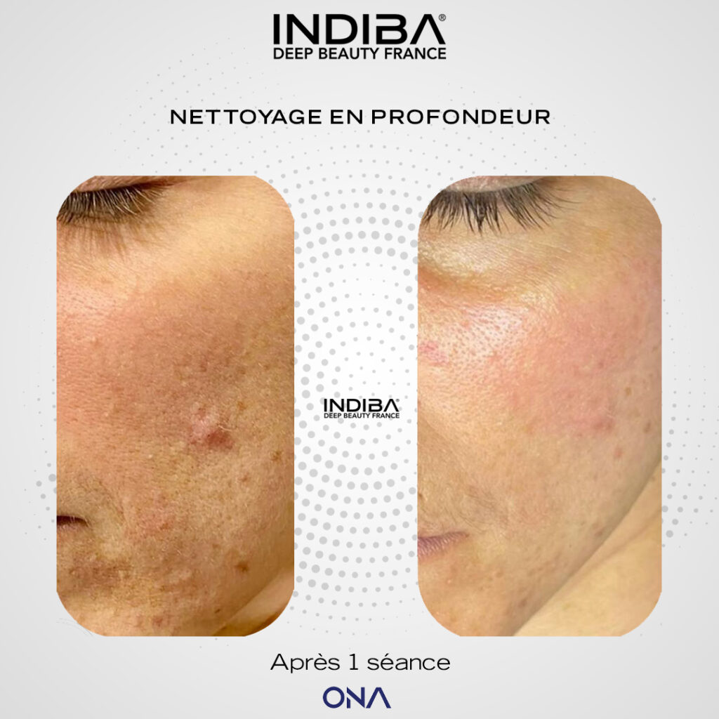 Nettoyage-visage-ONA.jpg