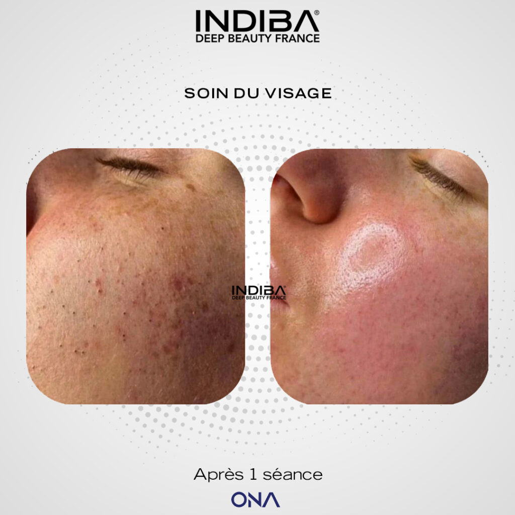 Nettoyage-visage-ONA-2.jpg