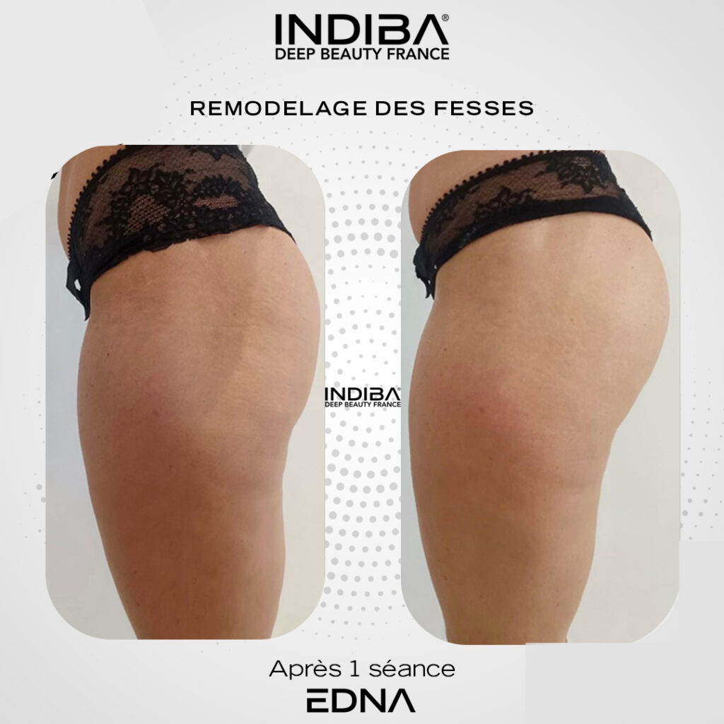 Remodelage-des-fesses.jpg