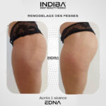 Remodelage-des-fesses.jpg