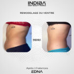 Remodelage-du-ventre-2.jpg
