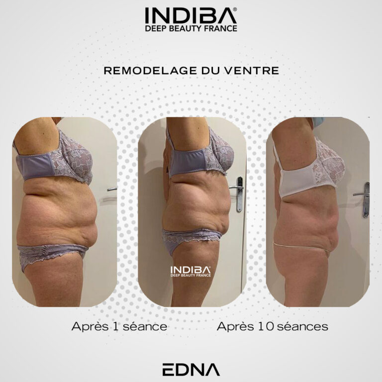 Remodelage-du-ventre-3.jpg