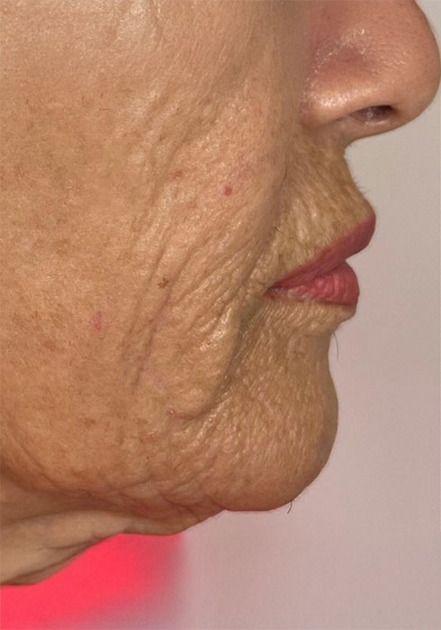 4-weeks_single-treatment_After.jpg