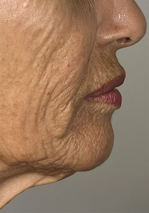 4-weeks_single-treatment_Before.jpg