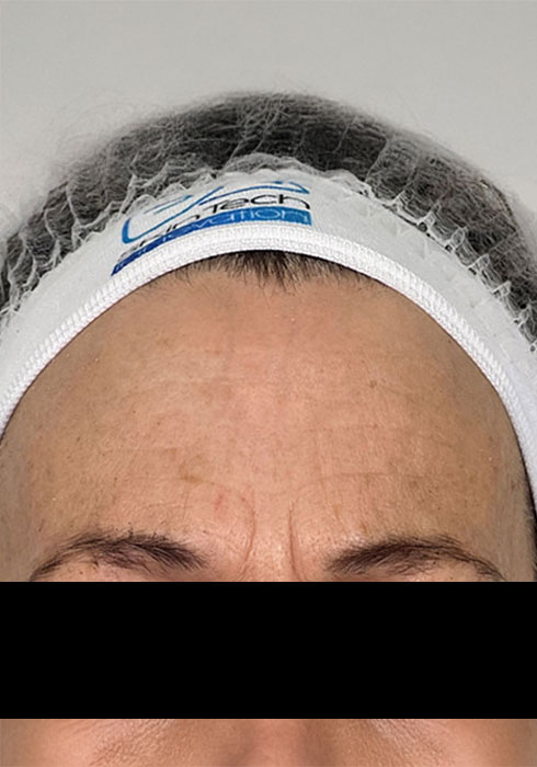 Forehead-lines_After.jpg