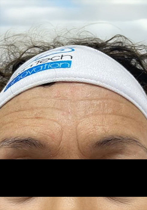 Forehead-lines_Before.jpg