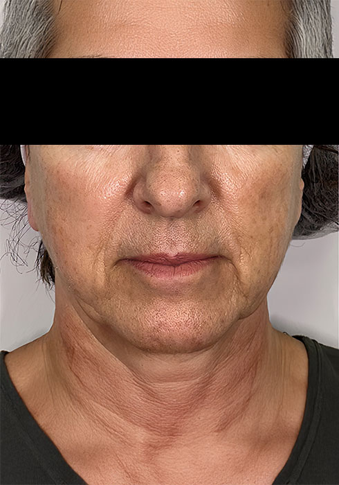Skin-lifting-and-tightening_After.jpg