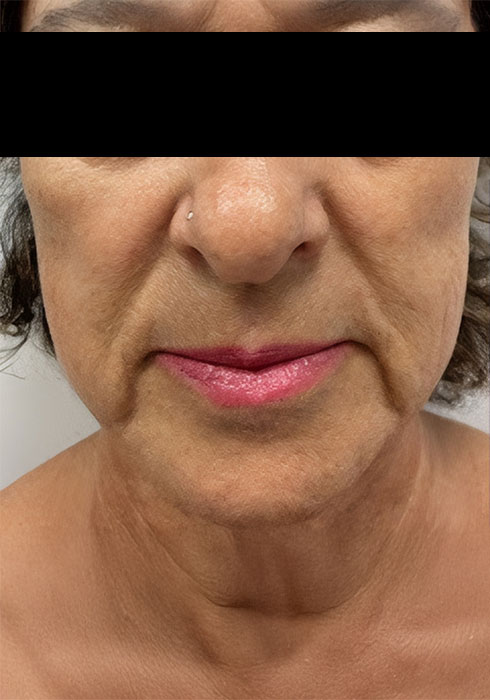 Skin-lifting-and-tightening_Before.jpg