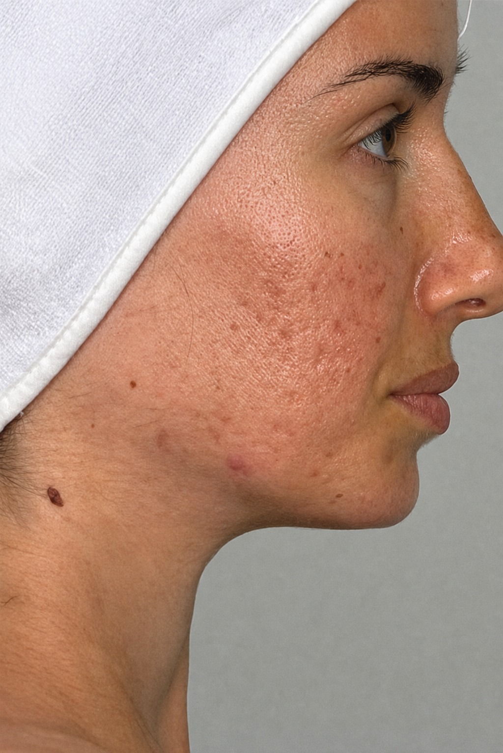avant-acne